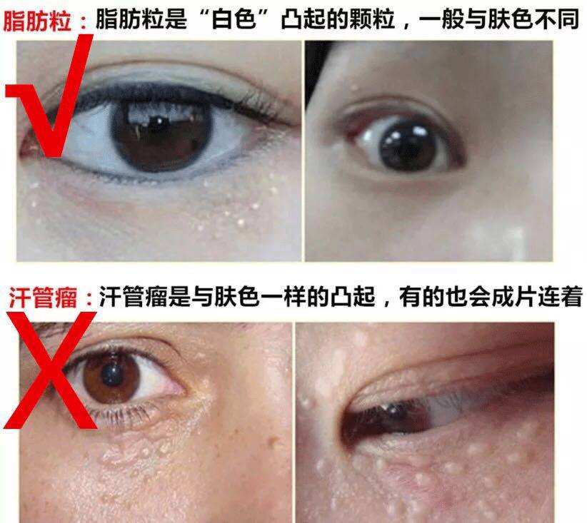 粟丘疹就是大家常说的脂肪粒,它是一种起源于表皮的良性肿物